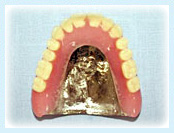 Photo: チタン床義歯